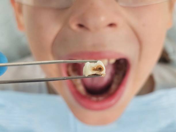 Best Dentist for Tooth Abscess  in Clarksville, VA